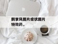 鹅掌风图片症状图片 特效药，